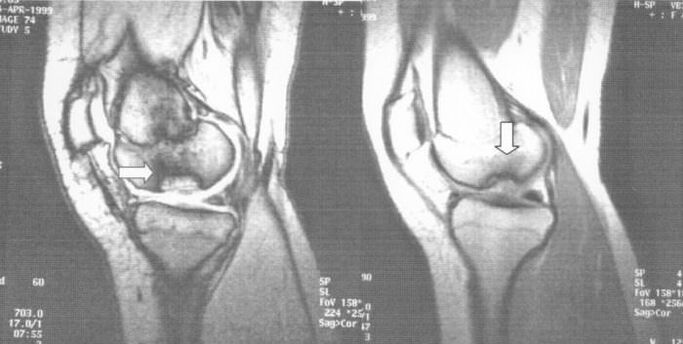 röntgenfoto van osteochondrose dissecans in het kniegewricht