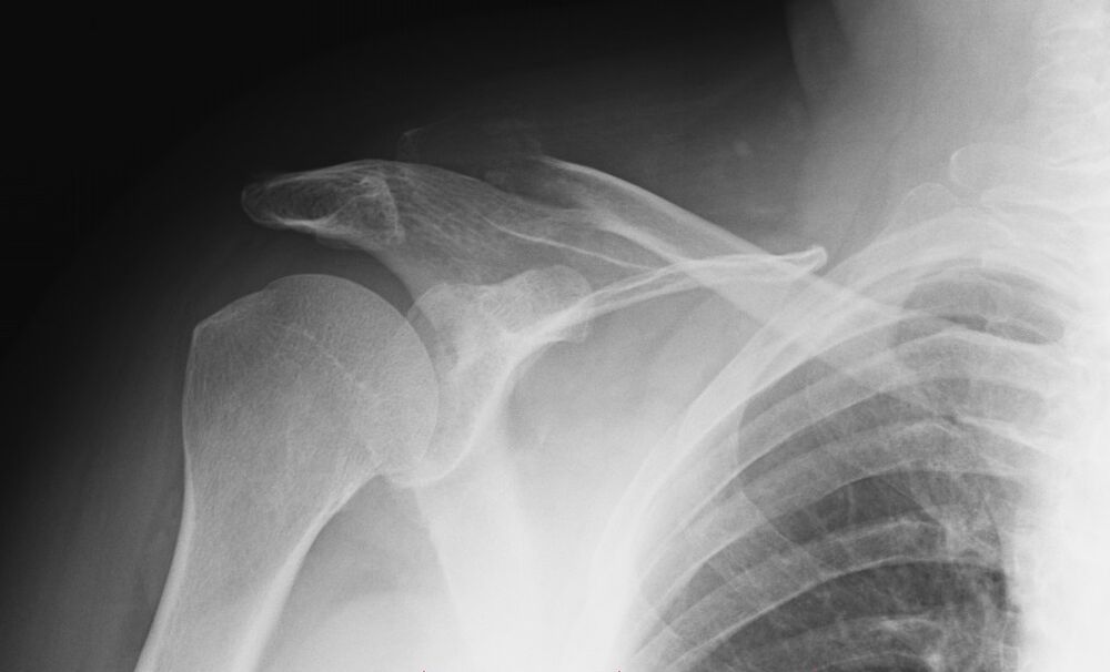 schouder artrose röntgenfoto