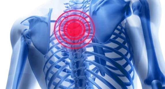 Behandeling van osteochondrose van de thoracale wervelkolom