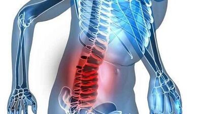 Tekenen en symptomen van lumbale osteochondrose