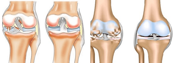 Artritis en artrose